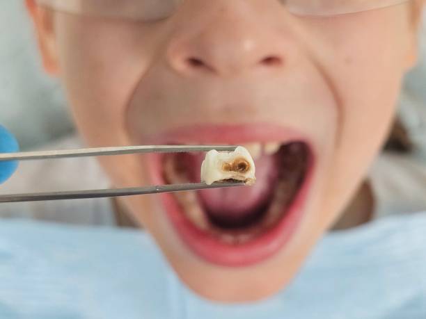 Best Emergency Dental Care for Sports Injuries in San Ramon, CA
